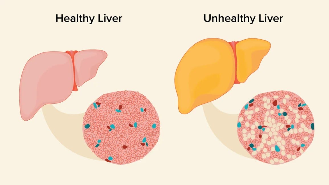 Healthy Liver vs Fatty Liver (NAFLD) Difference - Causes, Symptoms and Prevention